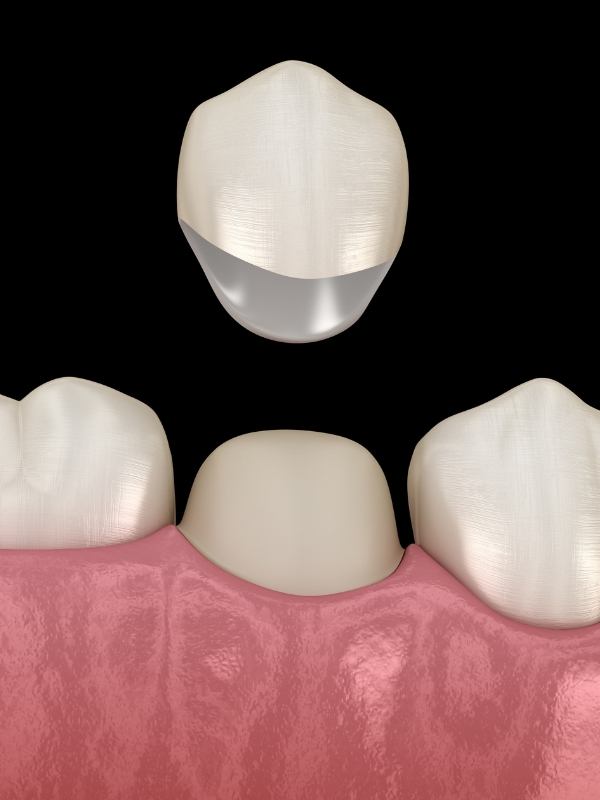 Dental Crown Procedure