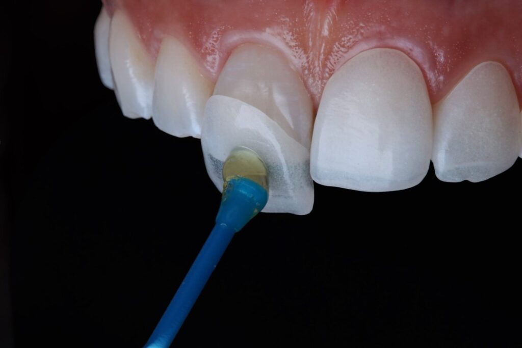 veneer for minimally prepped teeth