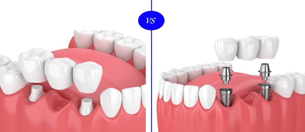 photo of dental implant bridge vs dental bridge