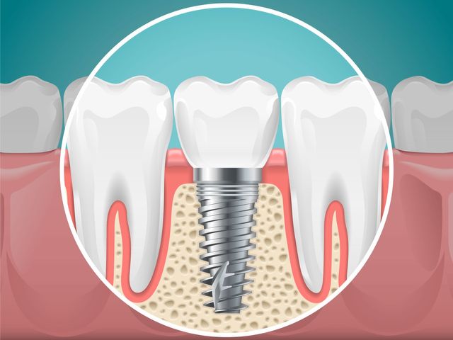 photo of tooth with dental implant