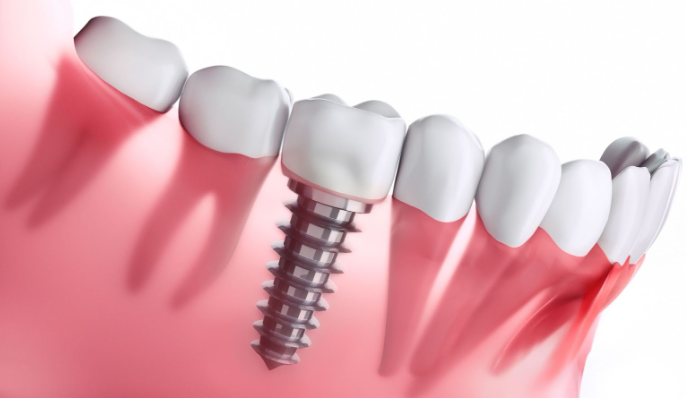 dental implant