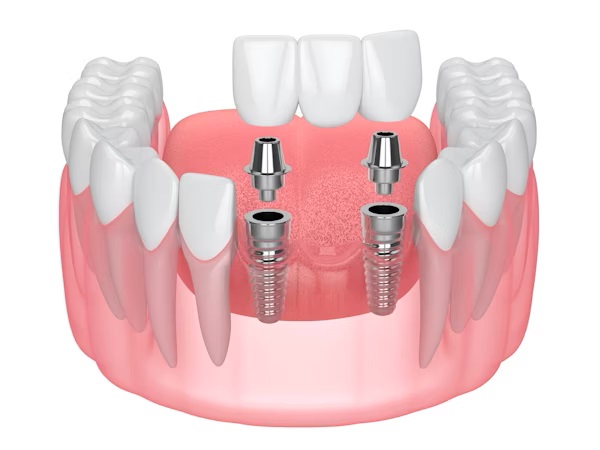 dental implant tooth replacement option